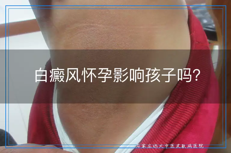 白癜风怀孕影响孩子吗？