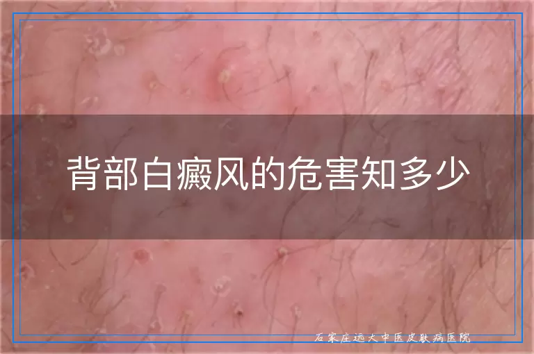 背部白癜风的危害知多少