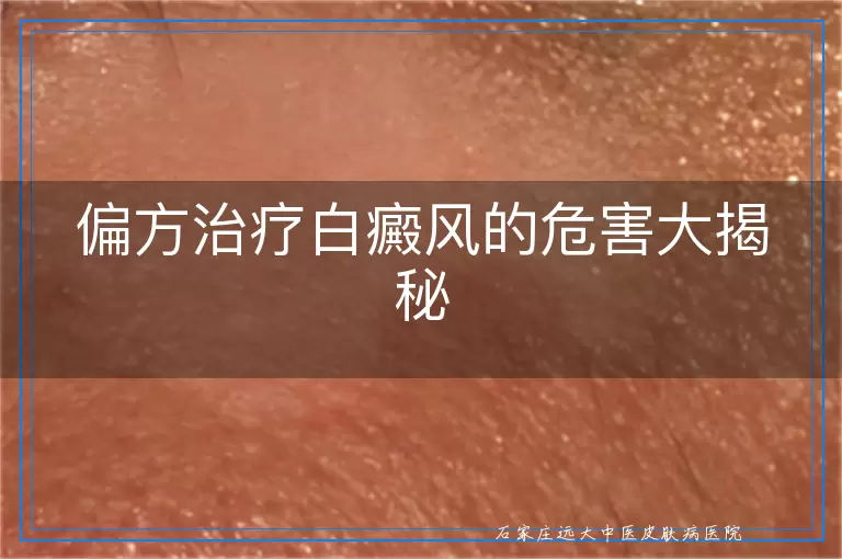 偏方治疗白癜风的危害大揭秘