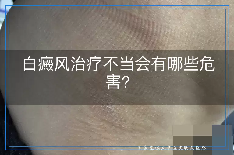 白癜风治疗不当会有哪些危害?
