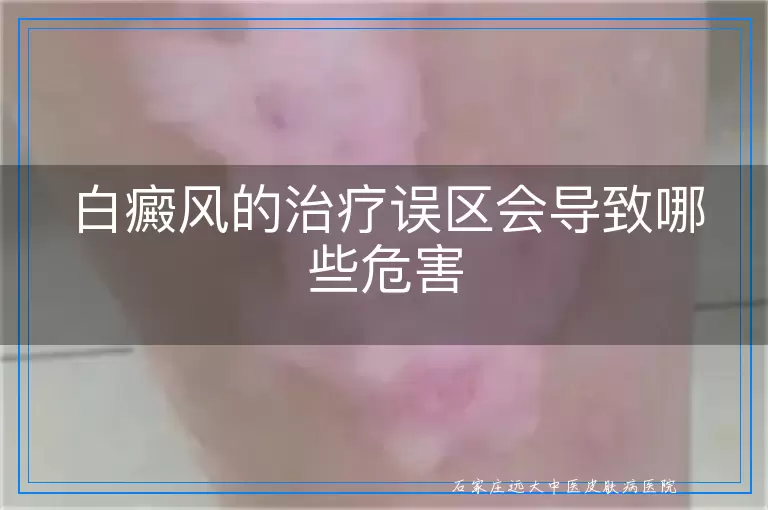 白癜风的治疗误区会导致哪些危害