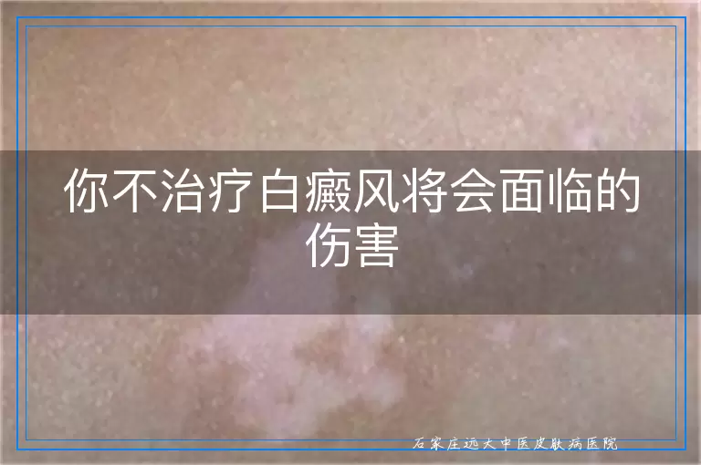 你不治疗白癜风将会面临的伤害