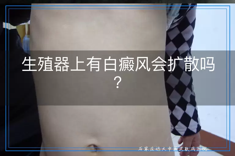 生殖器上有白癜风会扩散吗？