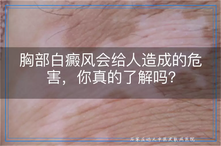 胸部白癜风会给人造成的危害，你真的了解吗？