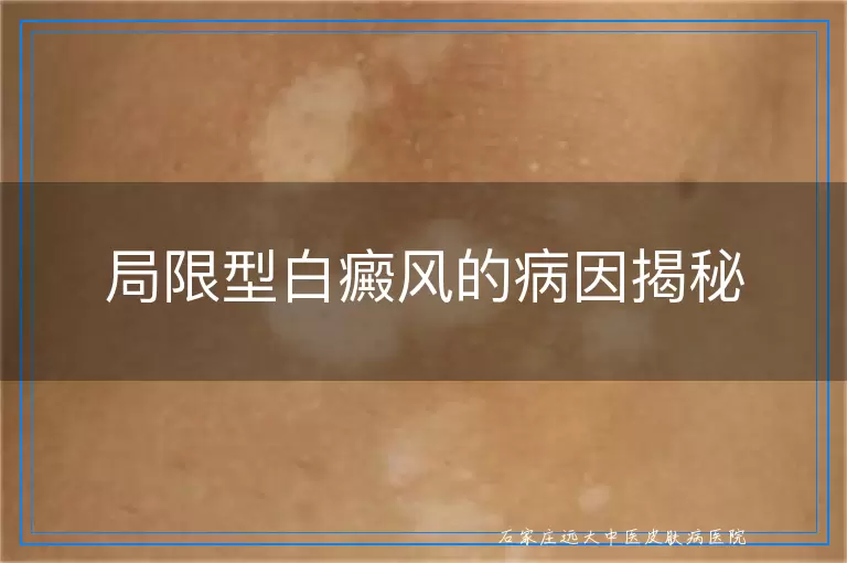 局限型白癜风的病因揭秘