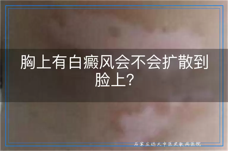 胸上有白癜风会不会扩散到脸上？
