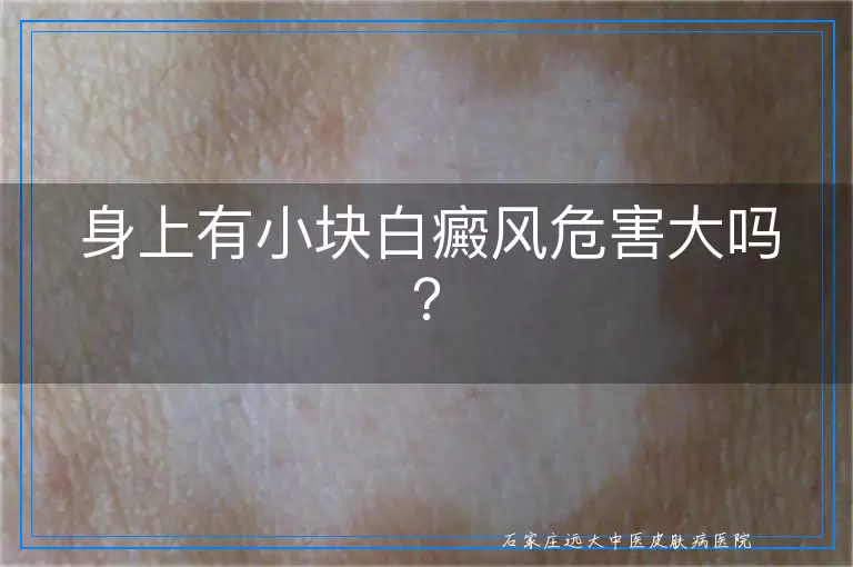 身上有小块白癜风危害大吗？