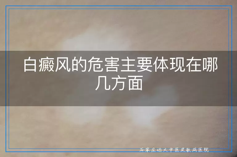 白癜风的危害主要体现在哪几方面