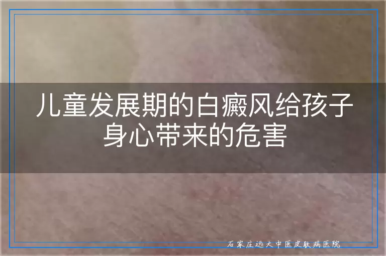 儿童发展期的白癜风给孩子身心带来的危害