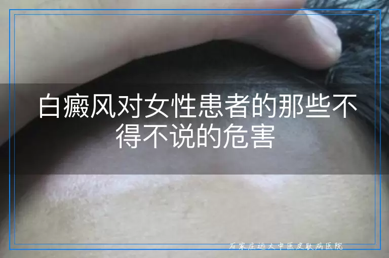 白癜风对女性患者的那些不得不说的危害