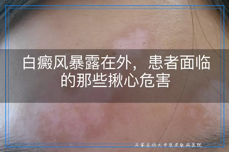 白癜风暴露在外，患者面临的那些揪心危害