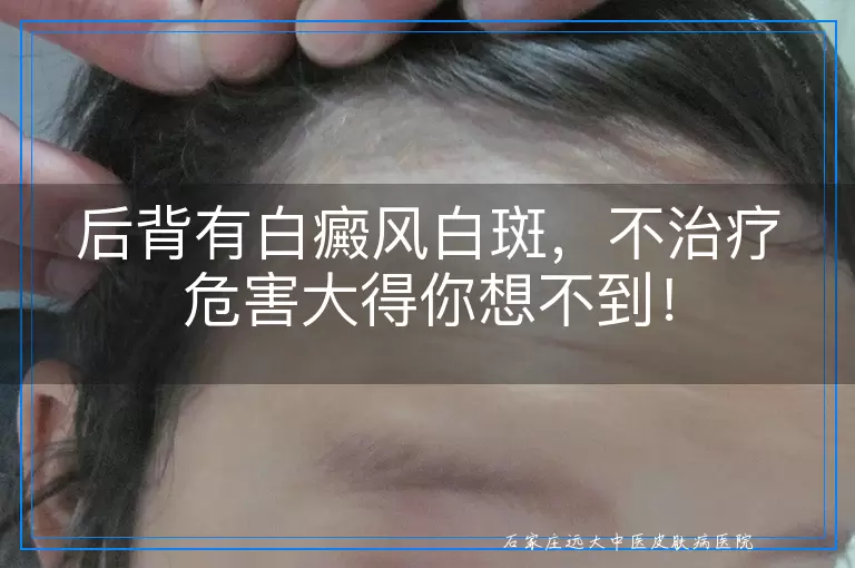 后背有白癜风白斑，不治疗危害大得你想不到！