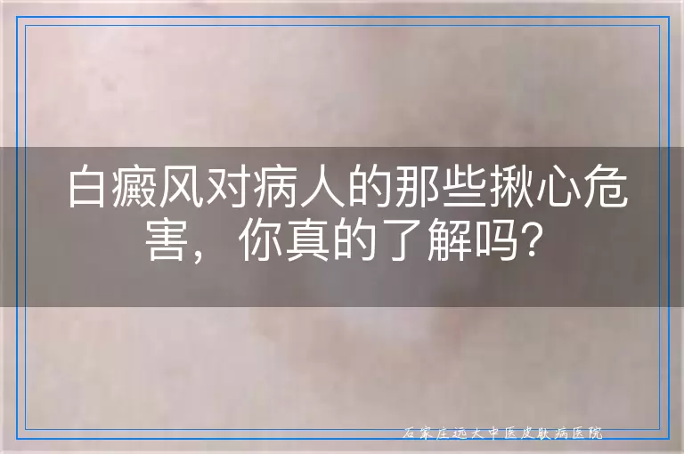 白癜风对病人的那些揪心危害，你真的了解吗？