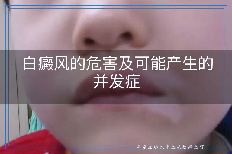 白癜风的危害及可能产生的并发症