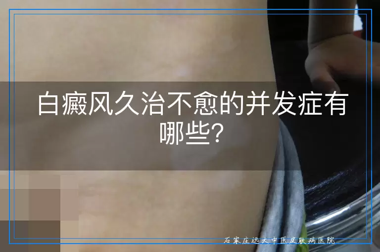 白癜风久治不愈的并发症有哪些？