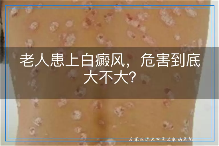 老人患上白癜风，危害到底大不大？