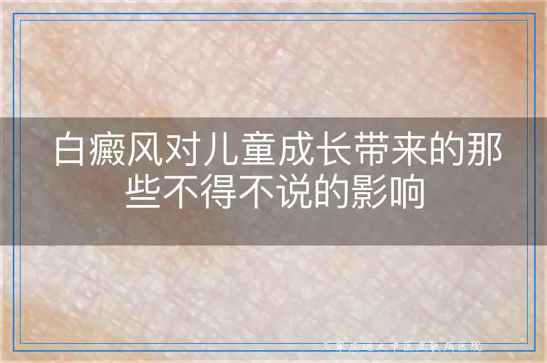 白癜风对儿童成长带来的那些不得不说的影响