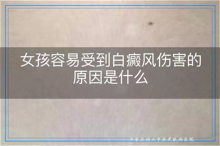 女孩容易受到白癜风伤害的原因是什么