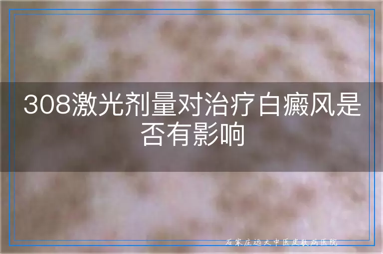 308激光剂量对治疗白癜风是否有影响