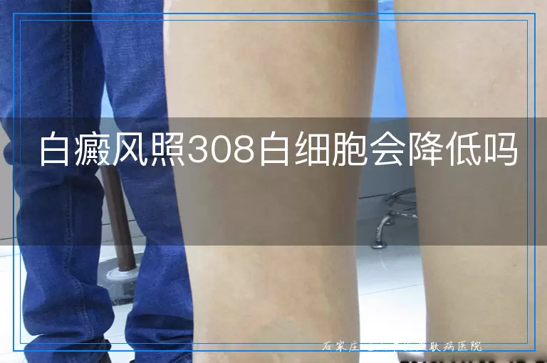白癜风照308白细胞会降低吗