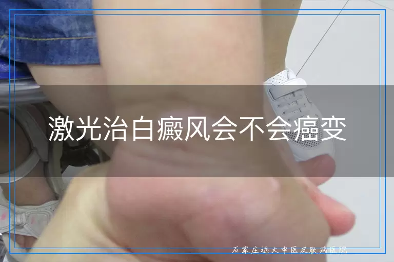 激光治白癜风会不会癌变