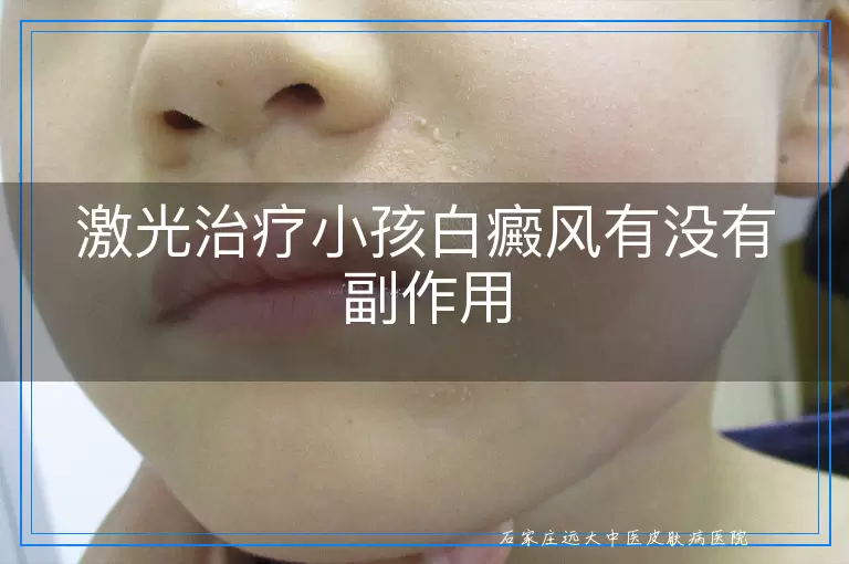 激光治疗小孩白癜风有没有副作用