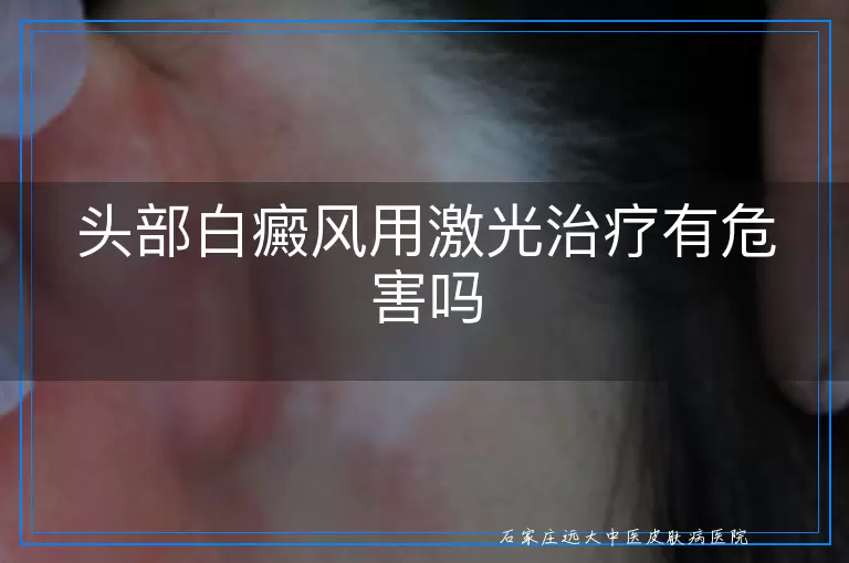 头部白癜风用激光治疗有危害吗