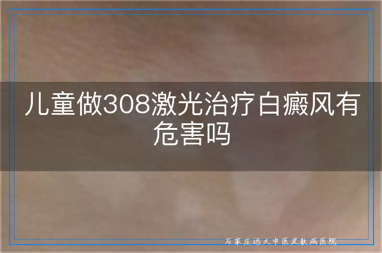 儿童做308激光治疗白癜风有危害吗