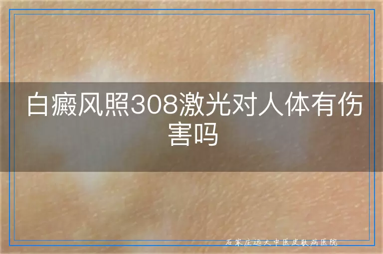 白癜风照308激光对人体有伤害吗