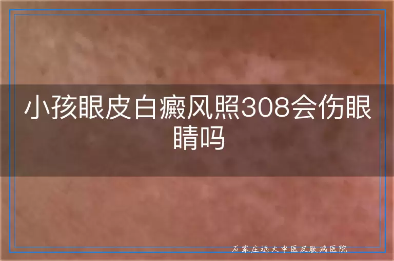 小孩眼皮白癜风照308会伤眼睛吗