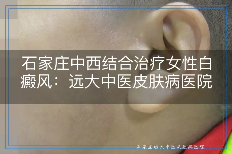 石家庄中西结合治疗女性白癜风:远大中医皮肤病医院优势解析