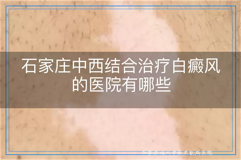石家庄中西结合治疗白癜风的医院有哪些