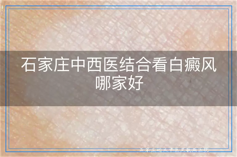 石家庄中西医结合看白癜风哪家好