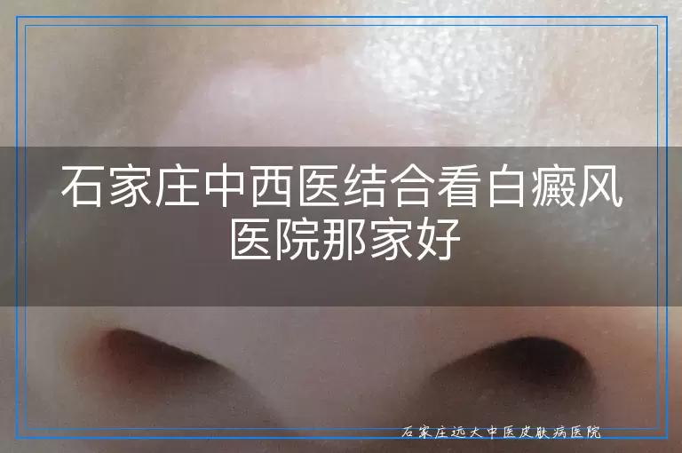 石家庄中西医结合看白癜风医院那家好