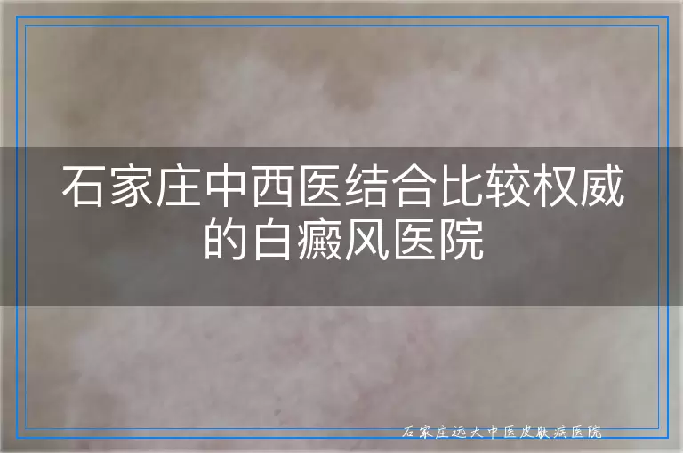 石家庄中西医结合比较权威的白癜风医院