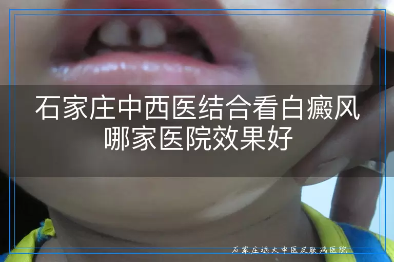 石家庄中西医结合看白癜风哪家医院效果好
