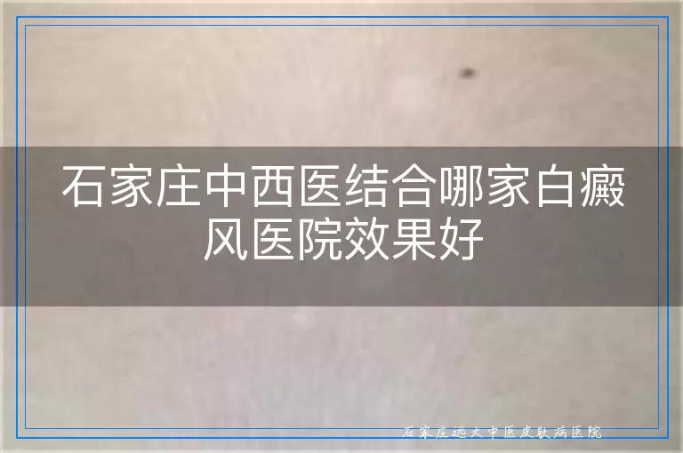 石家庄中西医结合哪家白癜风医院效果好