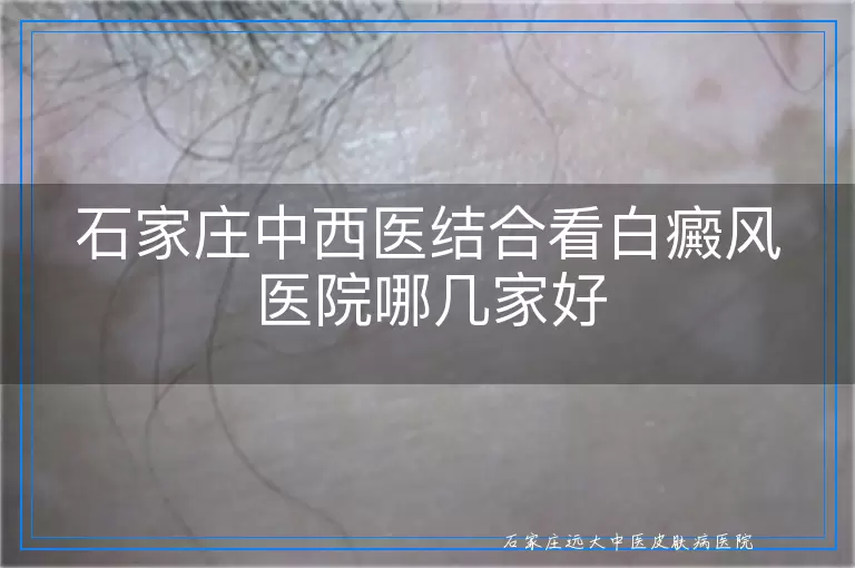 石家庄中西医结合看白癜风医院哪几家好
