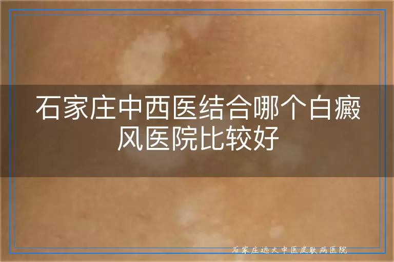石家庄中西医结合哪个白癜风医院比较好