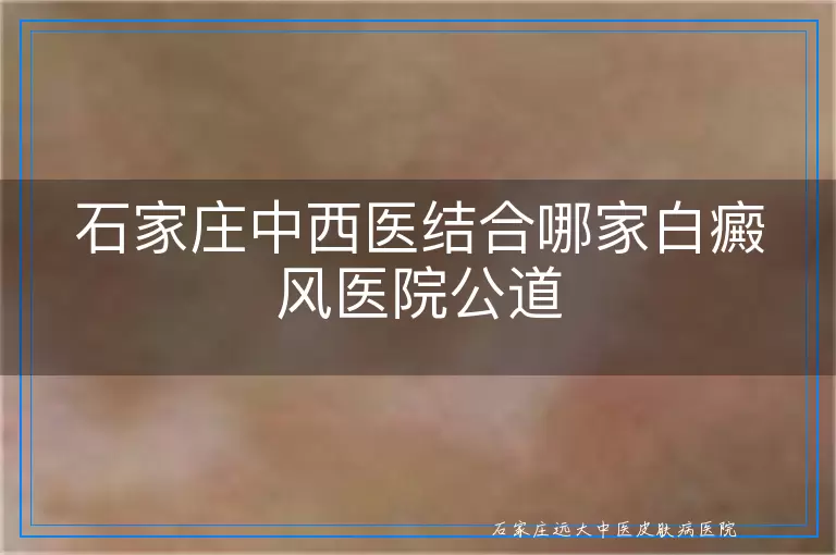 石家庄中西医结合哪家白癜风医院公道