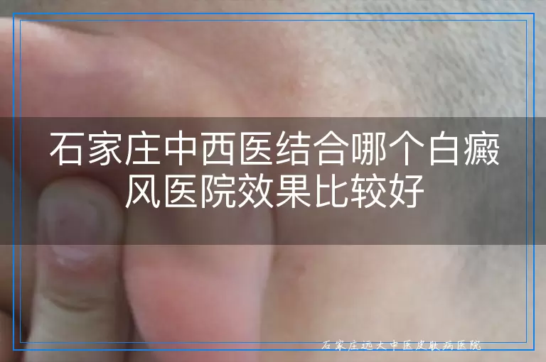 石家庄中西医结合哪个白癜风医院效果比较好