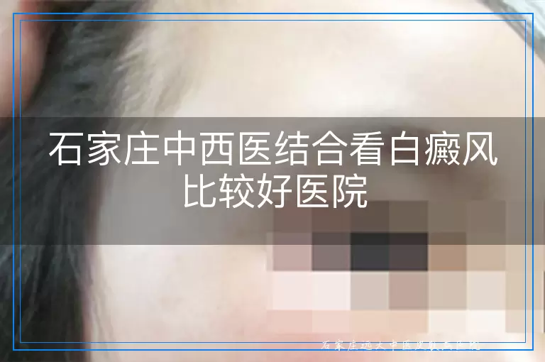 石家庄中西医结合看白癜风比较好医院
