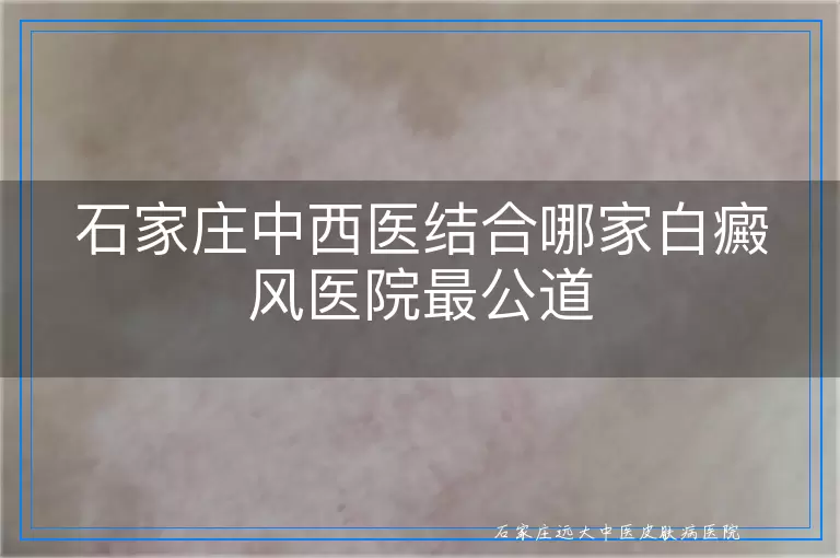 石家庄中西医结合哪家白癜风医院最公道