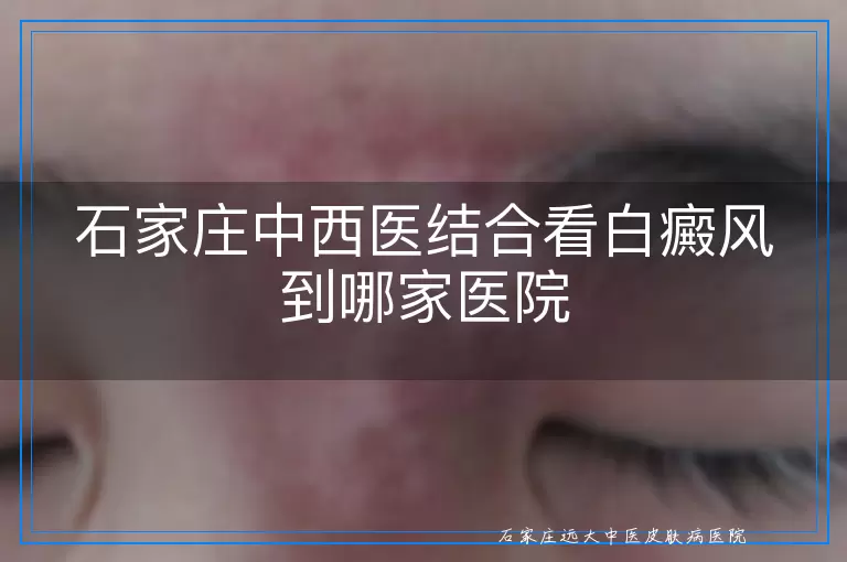 石家庄中西医结合看白癜风到哪家医院