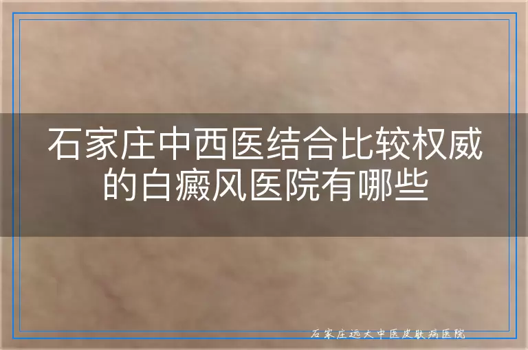 石家庄中西医结合比较权威的白癜风医院有哪些