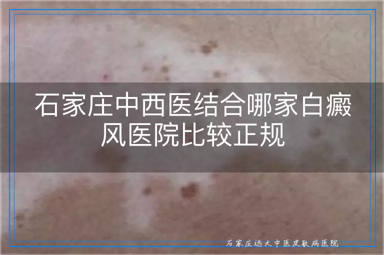 石家庄中西医结合哪家白癜风医院比较正规