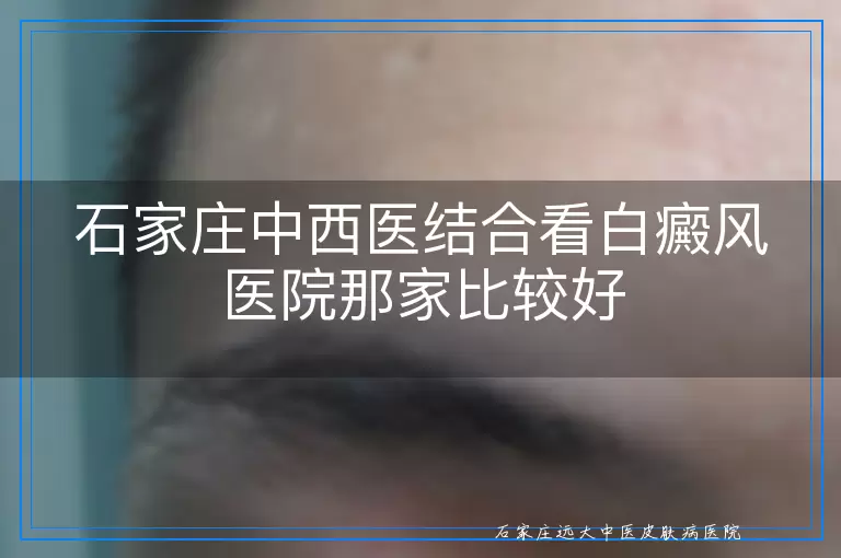 石家庄中西医结合看白癜风医院那家比较好