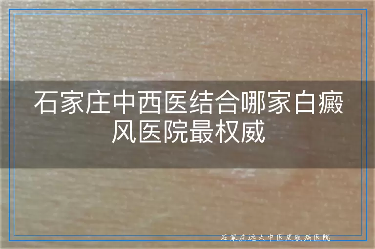 石家庄中西医结合哪家白癜风医院最权威