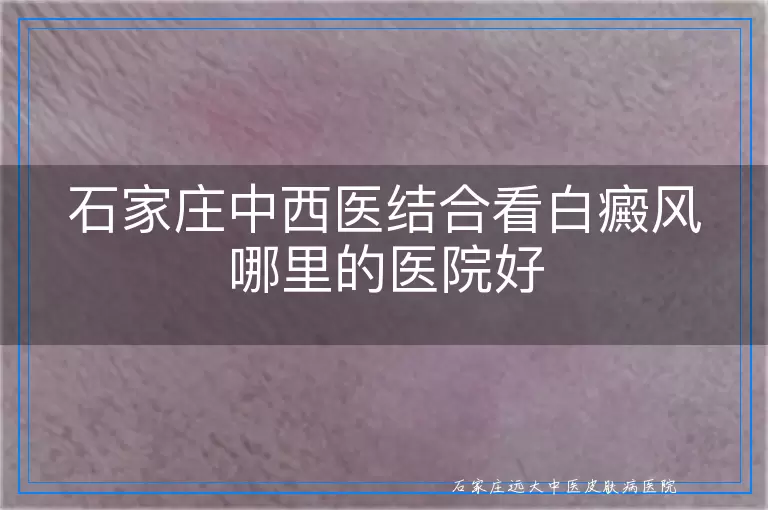 石家庄中西医结合看白癜风哪里的医院好
