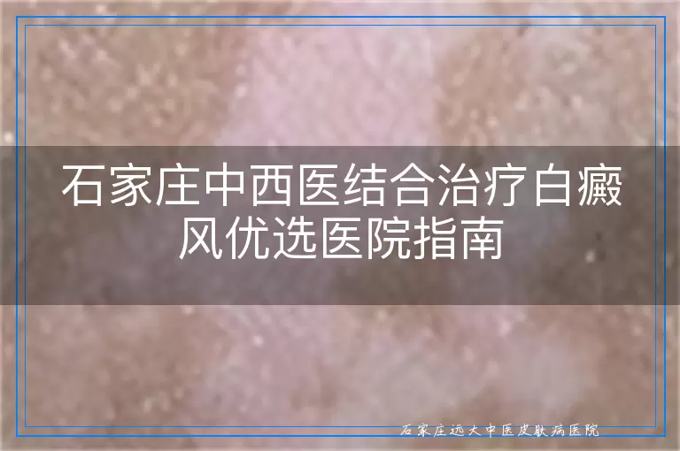 石家庄中西医结合治疗白癜风优选医院指南